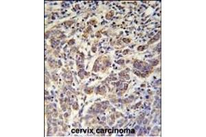 ANKRD57 Antibody (C-term) (ABIN651987 and ABIN2840483) immunohistochemistry analysis in formalin fixed and paraffin embedded human cervix carcinoma followed by peroxidase conjugation of the secondary antibody and DAB staining. (ANKRD57 抗体  (C-Term))