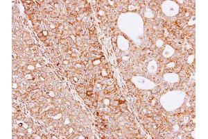 IHC-P Image Immunohistochemical analysis of paraffin-embedded Serous OVCA xenograft, using THUMPD3, antibody at 1:100 dilution. (THUMPD3 抗体)