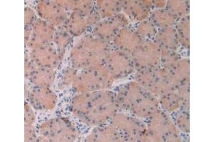 IHC-P analysis of Human Stomach Cancer Tissue, with DAB staining. (FGF19 抗体  (AA 4-216))