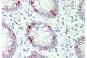 Rabbit Anti-STYK1 antibody  Formalin Fixed Paraffin Embedded Tissue: Human Colon Primary antibody Concentration: 1:100 Secondary Antibody: Donkey anti-Rabbit-Cy3 Secondary Antibody Concentration: 1:200 Magnification: 20x Exposure Time: 0. (STYK1 抗体  (C-Term))