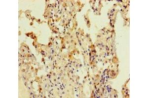 Immunohistochemistry of paraffin-embedded human lung cancer using ABIN7148108 at dilution of 1:100 (C12ORF68 抗体  (AA 1-194))