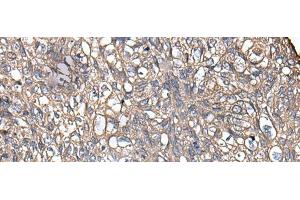 Immunohistochemistry of paraffin-embedded Human lung cancer tissue using KRT73 Polyclonal Antibody at dilution of 1:55(x200) (KRT73 抗体)