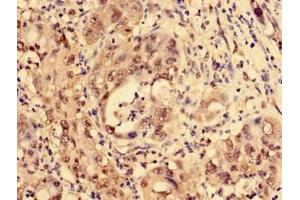 Immunohistochemistry of paraffin-embedded human liver cancer using ABIN7158369 at dilution of 1:100 (LIM Domain Binding 1 Protein 抗体  (AA 50-375))