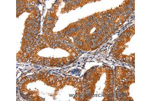 Immunohistochemistry of Human liver cancer using FGFR1 Polyclonal Antibody at dilution of 1:60 (FGFR1 抗体)