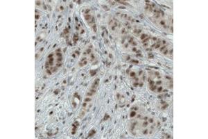 Immunohistochemical staining (Formalin-fixed paraffin-embedded sections) of human breast cancer with WHSC1 monoclonal antibody, clone CL1057  shows moderate nuclear immunoreactivity in tumor cells. (WHSC1 抗体)