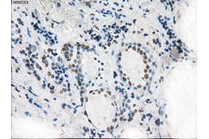 Immunohistochemical staining of paraffin-embedded Adenocarcinoma of colon tissue using anti-XRCC4mouse monoclonal antibody. (XRCC4 抗体)