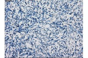 Immunohistochemical staining of paraffin-embedded Adenocarcinoma of breast tissue using anti-KDM4C mouse monoclonal antibody. (KDM4C 抗体)