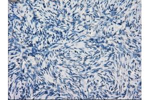 Immunohistochemical staining of paraffin-embedded Adenocarcinoma of breast tissue using anti-KDM4C mouse monoclonal antibody. (KDM4C 抗体)