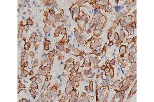 ABIN6276358 at 1/200 staining human breast cancer tissue sections by IHC-P. (IL-6 抗体  (Internal Region))