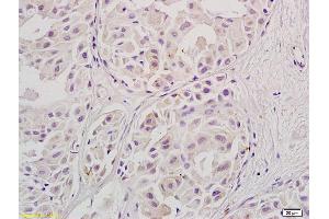 Formalin-fixed and paraffin embedded human ovary carcinoma labeled with Anti-Stra8, Unconjugated (ABIN736133) at 1:800, followed by conjugation to the secondary antibody and DAB staining. (STRA8 抗体  (AA 201-300))