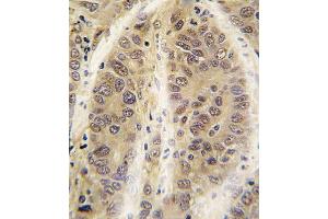 Formalin-fixed and paraffin-embedded human hepatocarcinoma tissue reacted with ADK antibody (C-term) (ABIN391132 and ABIN2841255) , which was peroxidase-conjugated to the secondary antibody, followed by DAB staining. (ADK 抗体  (C-Term))