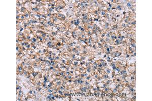 Immunohistochemistry of Human prostate cancer using ADAM12 Polyclonal Antibody at dilution of 1:40