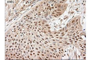 Immunohistochemical staining of paraffin-embedded Adenocarcinoma of breast using anti-NTF3 (ABIN2452548) mouse monoclonal antibody. (Neurotrophin 3 抗体  (AA 139-257))