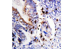 Anti-Bcl-XS antibody, IHC(P) IHC(P): Human Colon Cancer Tissue (BCL2L1 抗体  (Middle Region))