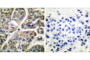 Peptide - +Immunohistochemical analysis of paraffin-embedded human breast carcinoma tissue using Granzyme B antibody (#C0215). (GZMB 抗体)