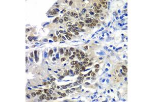 Immunohistochemistry of paraffin-embedded human colon carcinoma using DACH1 antibody (ABIN5972012) at dilution of 1/100 (40x lens). (DACH1 抗体)