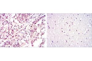 Immunohistochemical analysis of paraffin-embedded lung cancer (left) and brain tissues (right) using ATF2 mouse mAb with DAB staining. (ATF2 抗体)