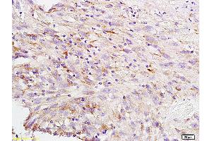 Formalin-fixed and paraffin embedded human brain glioblastoma labeled with Anti-CA II Polyclonal Antibody, Unconjugated (ABIN733298) at 1:200 followed by conjugation to the secondary antibody and DAB staining (CA2 抗体  (AA 201-260))