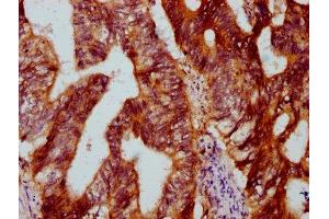 IHC image of ABIN7150800 diluted at 1:500 and staining in paraffin-embedded human colon cancer performed on a Leica BondTM system. (Dymeclin 抗体  (AA 224-348))