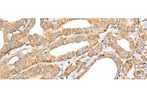Immunohistochemistry of paraffin-embedded Human thyroid cancer tissue using CCL5 Polyclonal Antibody at dilution of 1:50(x200) (CCL5 抗体)