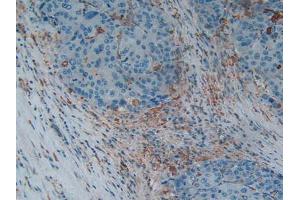 IHC-P analysis of Human Liver Cancer Tissue, with DAB staining. (Gelsolin 抗体  (AA 674-782))