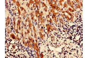 Immunohistochemistry analysis of human liver cancer using ABIN7147768 at dilution of 1:100 (CFAP61 抗体  (AA 1-200))