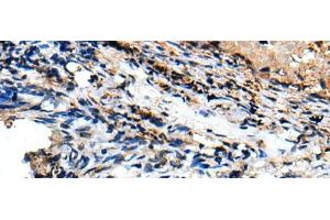 Immunohistochemistry of paraffin-embedded Human lung cancer tissue using CSRP3 Polyclonal Antibody at dilution of 1:40(x200) (CSRP3 抗体)