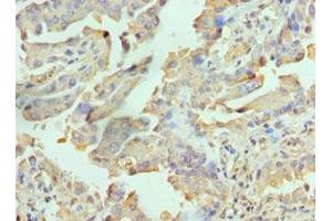 Immunohistochemistry of paraffin-embedded human lung cancer using ABIN7167113 at dilution of 1:100 (RICTOR 抗体  (AA 1-245))