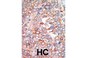 Formalin-fixed and paraffin-embedded human hepatocellular carcinoma tissue reacted with the STK24 polyclonal antibody  , which was peroxidase-conjugated to the secondary antibody, followed by AEC staining. (STK24 抗体  (C-Term))