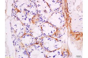Formalin-fixed and paraffin embedded human laryngocarcinoma labeled with Anti-DNase II Polyclonal Antibody, Unconjugated  at 1:200 followed by conjugation to the secondary antibody and DAB staining. (DNASE2 抗体  (AA 25-90))