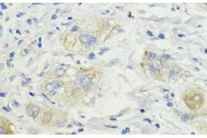 Immunohistochemistry of paraffin-embedded Human liver cancer using SURF4 Polyclonal Antibody at dilution of 1:200 (40x lens). (Surfeit 4 抗体)