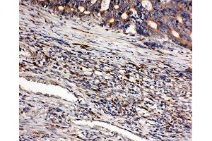 IHC-P: CD163 antibody testing of human intestinal cancer tissue (CD163 抗体  (AA 1056-1165))