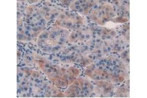 IHC-P analysis of Human Liver Cancer Tissue, with DAB staining. (GDF5 抗体  (AA 86-501))