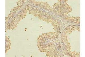 Immunohistochemistry of paraffin-embedded human prostate cancer using ABIN7164073 at dilution of 1:100 (PQLC3 抗体  (AA 118-170))