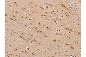 The image on the left is immunohistochemistry of paraffin-embedded Human brain tissue using ABIN7192440(SLC25A20 Antibody) at dilution 1/30, on the right is treated with synthetic peptide. (SLC25A2 抗体)