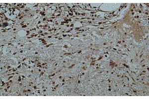 Immunohistochemistry of paraffin-embedded Human colon tissue using Galectin 3 Monoclonal Antibody at dilution of 1:50. (Galectin 3 抗体)