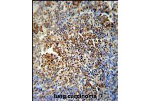MAF1 antibody immunohistochemistry analysis in formalin fixed and paraffin embedded human lung carcinoma followed by peroxidase conjugation of the secondary antibody and DAB staining. (MAF1 抗体  (AA 90-117))