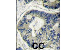 Formalin-fixed and paraffin-embedded human colon carcinoma reacted with AKT2 polyclonal antibody  , which was peroxidase-conjugated to the secondary antibody, followed by DAB staining . (AKT2 抗体  (N-Term))