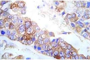 Immunohistochemistry analysis of Fyn antibody pTyr530 in paraffin-embedded Human breast carcinoma tissue. (FYN 抗体  (pTyr530))