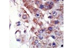 IHC analysis of FFPE human hepatocarcinoma tissue stained with the JNK2 antibody (JNK2 抗体  (AA 349-379))