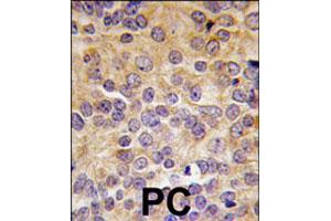 Formalin-fixed and paraffin-embedded human prostate carcinoma tissue reacted with PRMT3 polyclonal antibody  , which was peroxidase-conjugated to the secondary antibody, followed by DAB staining. (PRMT3 抗体  (N-Term))