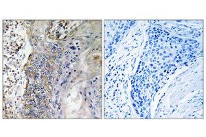 Immunohistochemistry analysis of paraffin-embedded human lung carcinoma tissue, using SLC28A2 antibody. (SLC28A2 抗体  (Internal Region))