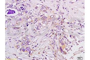 Formalin-fixed and paraffin embedded human colon carcinoma tissue labeled with Anti-Tsg101 Polyclonal Antibody (ABIN685507), Unconjugated at 1:200 followed by conjugation to the secondary antibody, (SP-0023), and DAB staining