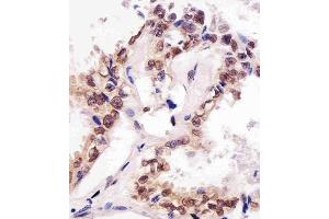 (ABIN387785 and ABIN2838022) staining SUMO1 in human lung adenocarcinoma tissue sections by Immunohistochemistry (IHC-P - paraformaldehyde-fixed, paraffin-embedded sections). (SUMO1 抗体)