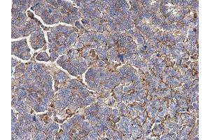 IHC-P Image MMP1 antibody detects MMP1 protein at secreted on human endometrial carcinoma by immunohistochemical analysis. (MMP1 抗体)