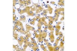 Immunohistochemical analysis of GLUD2 staining in human liver cancer formalin fixed paraffin embedded tissue section. (GLUD2 抗体)