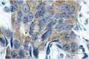 Immunohistochemistry (IHC) analyzes of p-Catenin-beta antibody in paraffin-embedded human colon carcinoma tissue. (CTNNB1 抗体  (pSer33))