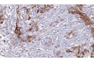 ABIN6277346 at 1/100 staining Human urothelial cancer tissue by IHC-P. (SLC18A2 抗体  (C-Term))