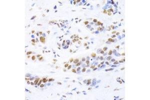 Immunohistochemistry of paraffin-embedded human breast cancer using XRCC5 Antibody.