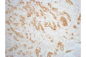 Immunohistochemistry (IHC) staining of Mouse prostate adenocarcinoma tissue, diluted at 1:200. (AMACR 抗体)
